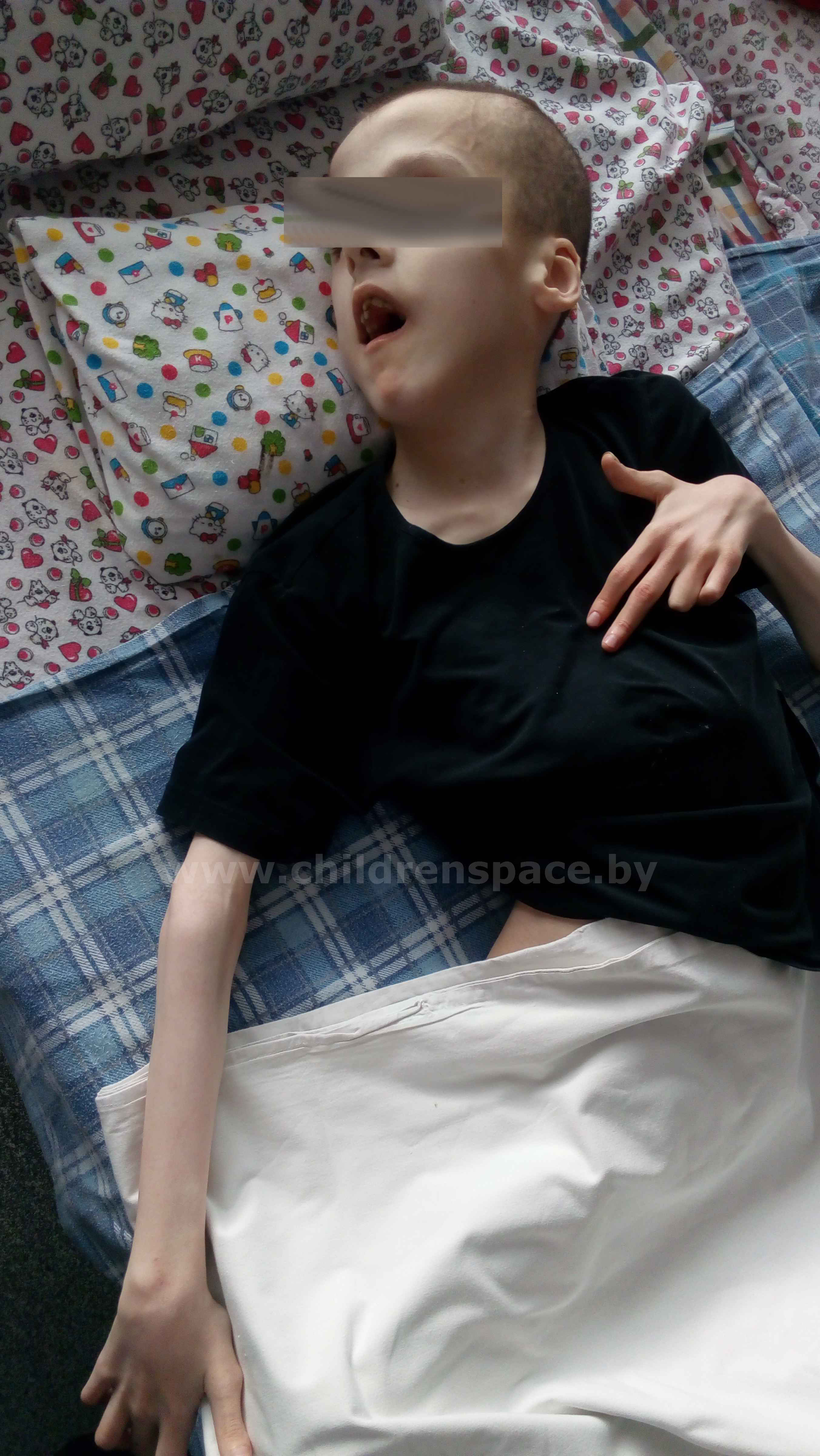 парень  с  синдромом  марфана  на  кровати